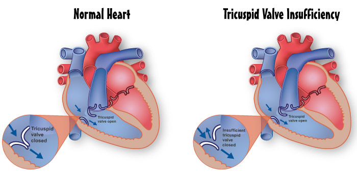Tricuspid Valve Insufficiency diagram